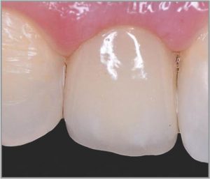 Crown Build-up by AvueCore Nano Performed by Dr. Shivangi Jain.
