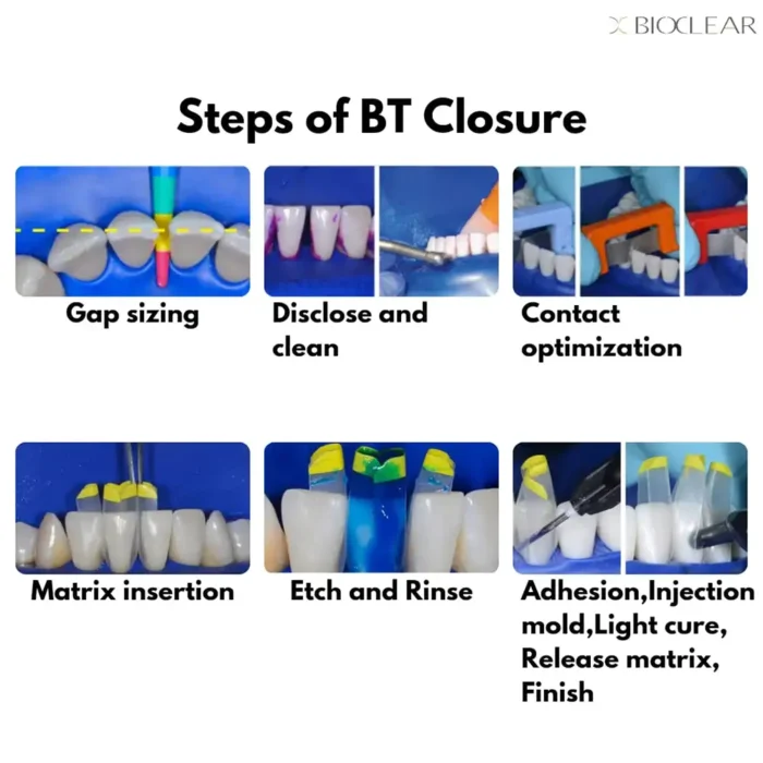 BioClear-Black-Triangle-Steps-of-Closure