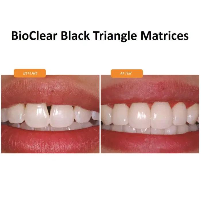 BioClear-Black-Triangle-Treatment-Case