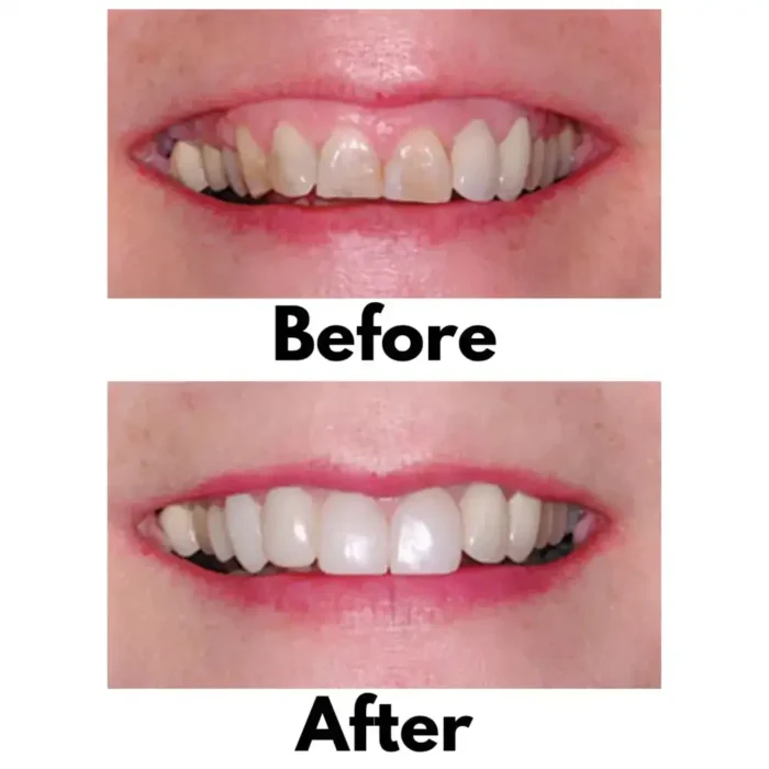 Bioclear 360° Veneer Matrices Before and After