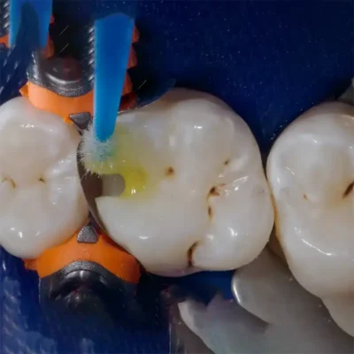 Coltene One Coat Bond SL on teeth