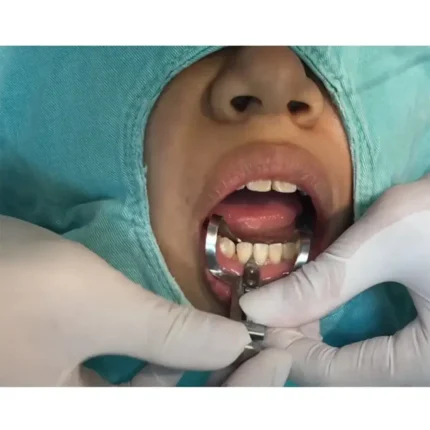 GDC Tooth Separator Elliot (TSE) as Demo